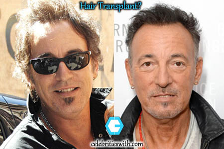 Bruce-Springsteen-Plastic-Surgery-Hair-Transplant.jpg